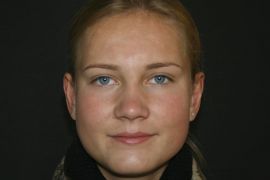 Ohren anlegen Bild nach OP 7